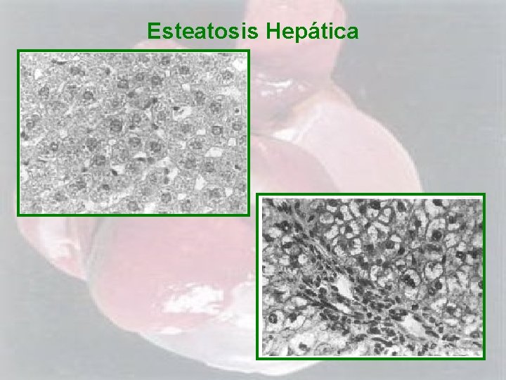 Esteatosis Hepática 