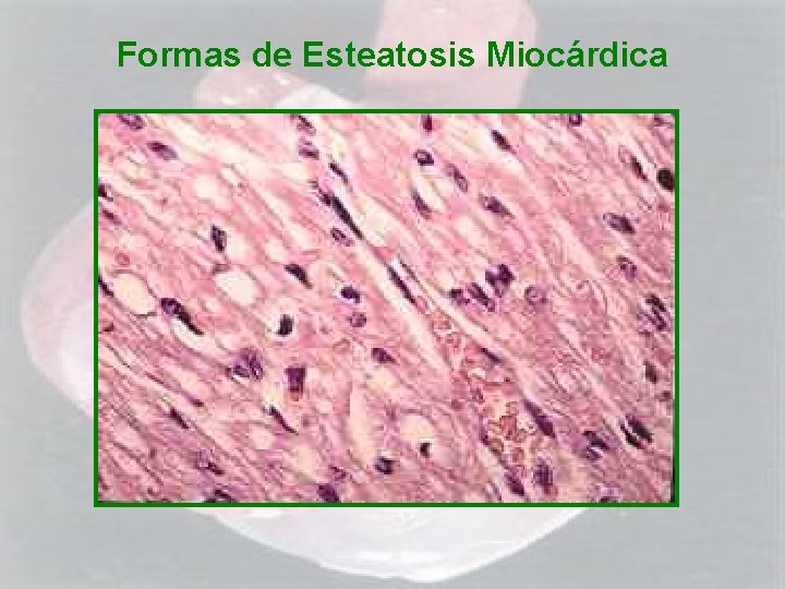 Formas de Esteatosis Miocárdica 