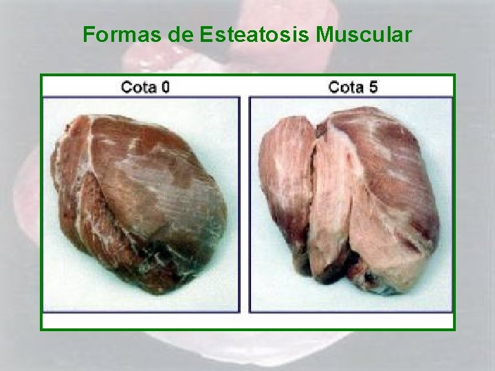 Formas de Esteatosis Muscular 