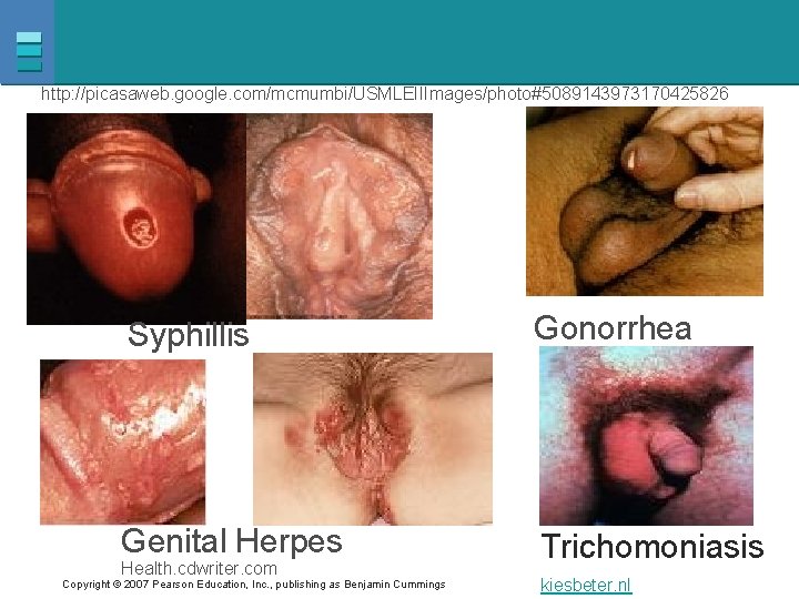 http: //picasaweb. google. com/mcmumbi/USMLEIIImages/photo#5089143973170425826 Syphillis Gonorrhea Genital Herpes Trichomoniasis Health. cdwriter. com Copyright ©