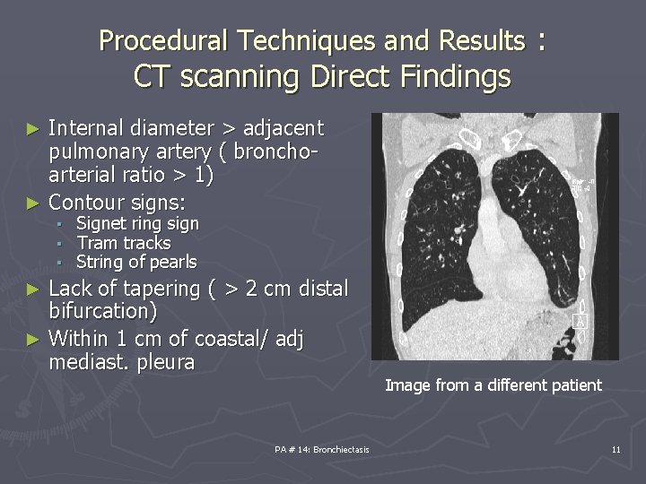 Procedural Techniques and Results : CT scanning Direct Findings Internal diameter > adjacent pulmonary