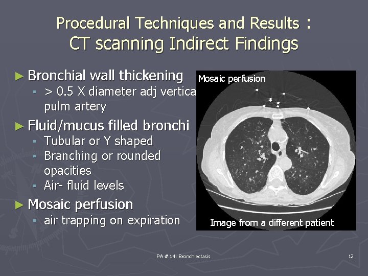 Procedural Techniques and Results : CT scanning Indirect Findings ► Bronchial wall thickening Mosaic