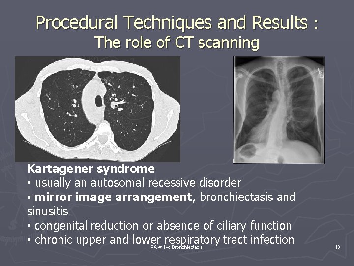 Procedural Techniques and Results : The role of CT scanning Kartagener syndrome • usually