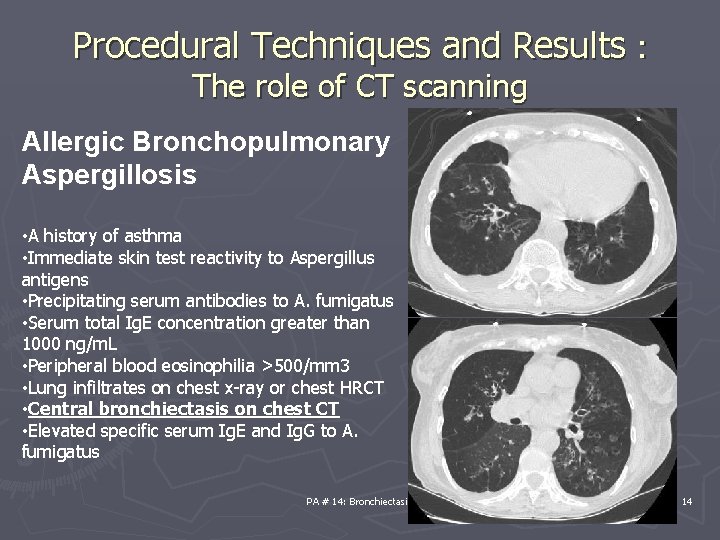 Procedural Techniques and Results : The role of CT scanning Allergic Bronchopulmonary Aspergillosis •