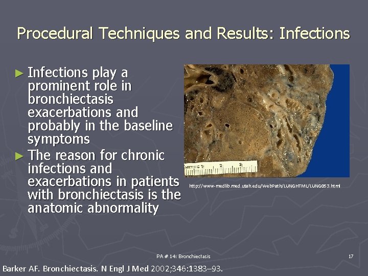 Procedural Techniques and Results: Infections ► Infections play a prominent role in bronchiectasis exacerbations