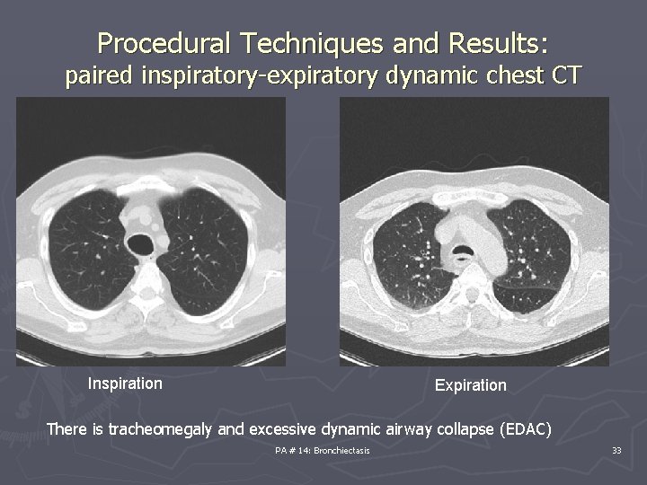 Procedural Techniques and Results: paired inspiratory-expiratory dynamic chest CT Inspiration Expiration There is tracheomegaly