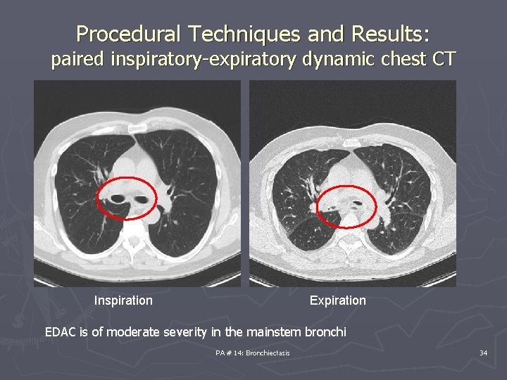Procedural Techniques and Results: paired inspiratory-expiratory dynamic chest CT Inspiration Expiration EDAC is of