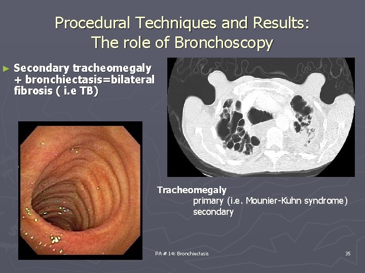 Procedural Techniques and Results: The role of Bronchoscopy ► Secondary tracheomegaly + bronchiectasis=bilateral fibrosis