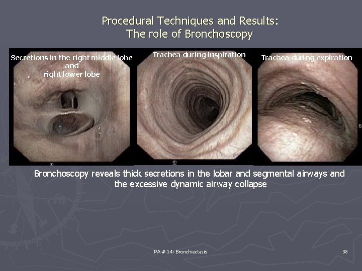 Procedural Techniques and Results: The role of Bronchoscopy Secretions in the right middle lobe