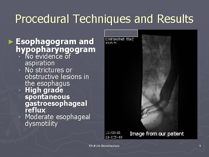 Procedural Techniques and Results ► Esophagogram and hypopharyngogram ▪ No evidence of aspiration ▪