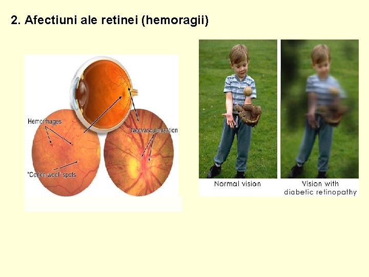 2. Afectiuni ale retinei (hemoragii) 