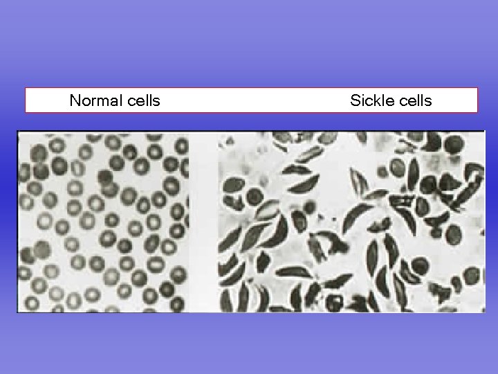 Normal cells Sickle cells 