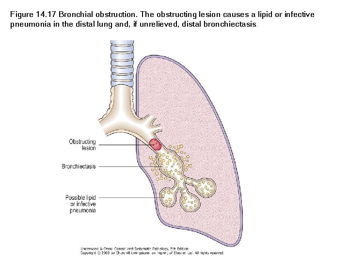 Figure 14. 17 Bronchial obstruction. The obstructing lesion causes a lipid or infective pneumonia