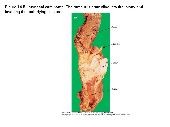Figure 14. 5 Laryngeal carcinoma. The tumour is protruding into the larynx and invading