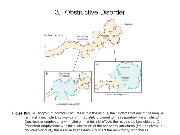 3. Obstructive Disorder Figure 15 -5 A, Diagram of normal structures within the acinus,