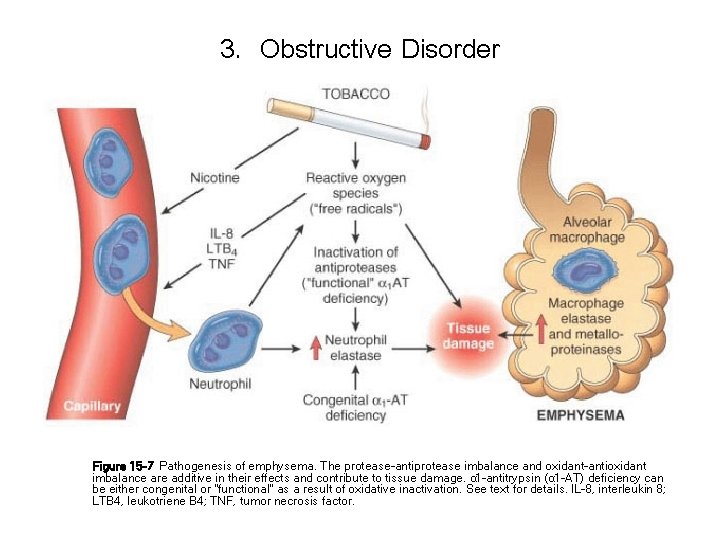 3. Obstructive Disorder Figure 15 -7 Pathogenesis of emphysema. The protease-antiprotease imbalance and oxidant-antioxidant