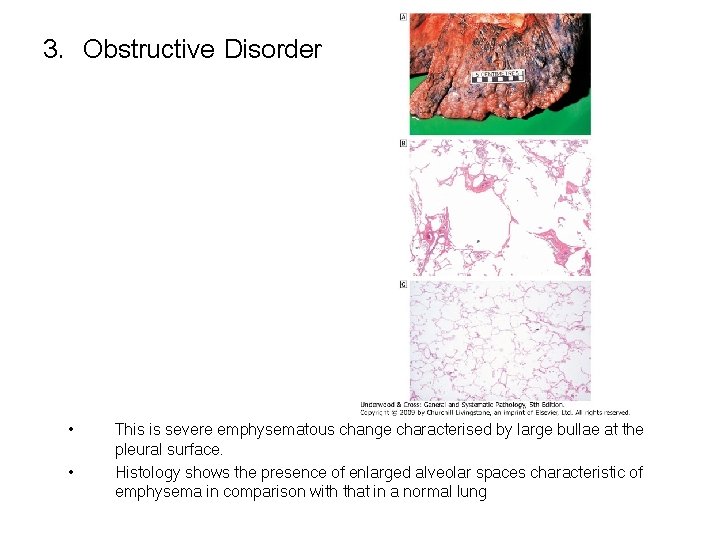 3. Obstructive Disorder • • This is severe emphysematous change characterised by large bullae