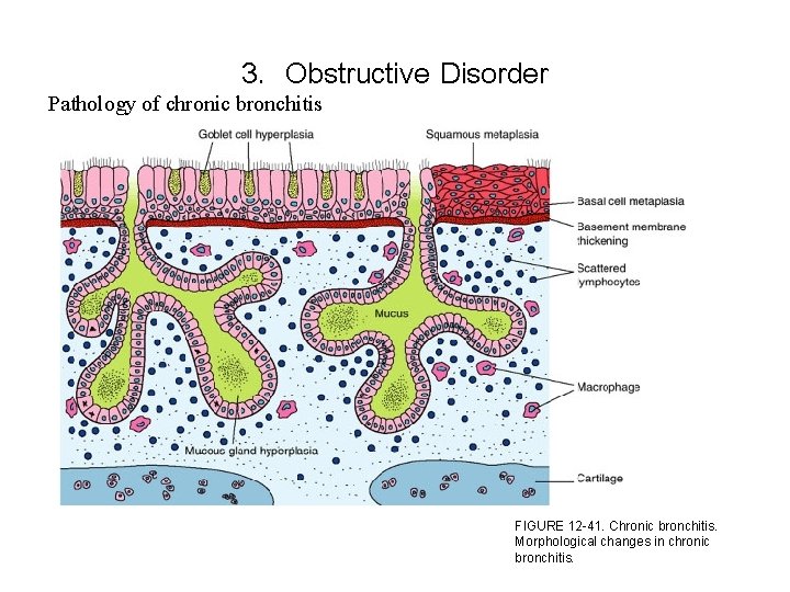 3. Obstructive Disorder Pathology of chronic bronchitis FIGURE 12 -41. Chronic bronchitis. Morphological changes