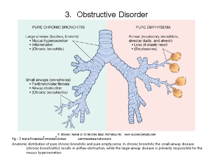3. Obstructive Disorder fig - 3 พยาธกำเนดของโรคถงลมโปงพอง และหลอดลมอกเสบเรอรง Anatomic distribution of pure chronic bronchitis