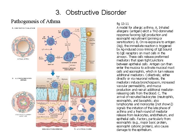 3. Obstructive Disorder Pathogenesis of Athma fig 13 -11 A model for allergic asthma.