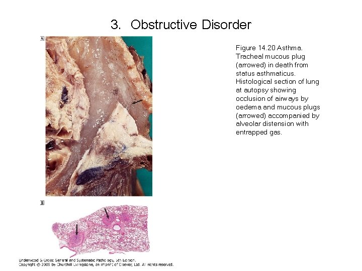 3. Obstructive Disorder Figure 14. 20 Asthma. Tracheal mucous plug (arrowed) in death from