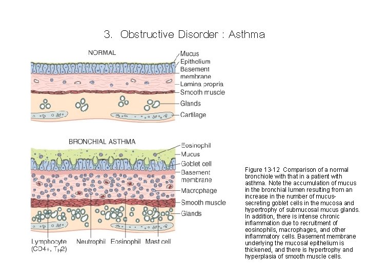 3. Obstructive Disorder : Asthma Figure 13 -12 Comparison of a normal bronchiole with