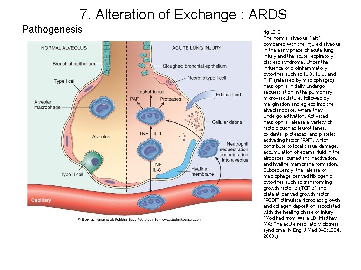 7. Alteration of Exchange : ARDS Pathogenesis fig 13 -3 The normal alveolus (left)