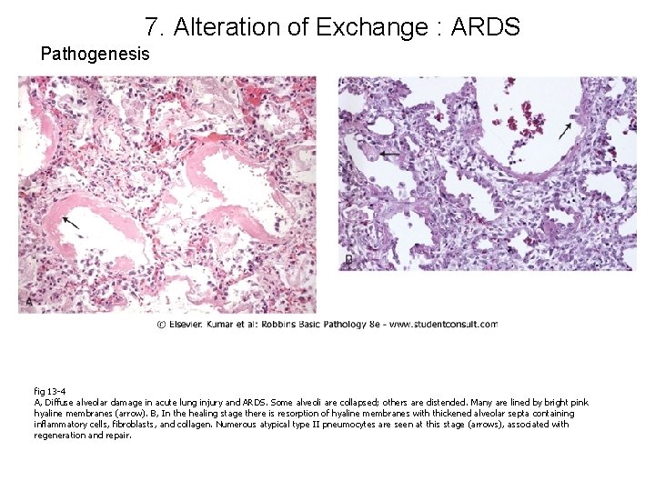 7. Alteration of Exchange : ARDS Pathogenesis fig 13 -4 A, Diffuse alveolar damage