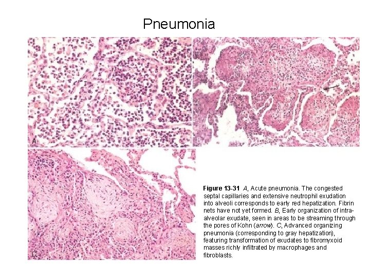 Pneumonia Figure 13 -31 A, Acute pneumonia. The congested septal capillaries and extensive neutrophil