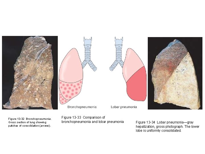 Figure 13 -32 Bronchopneumonia. Gross section of lung showing patches of consolidation (arrows). Figure
