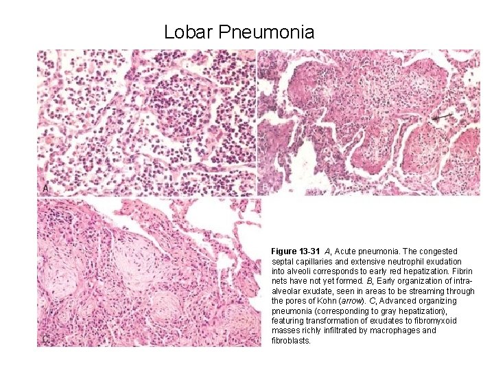 Lobar Pneumonia Figure 13 -31 A, Acute pneumonia. The congested septal capillaries and extensive