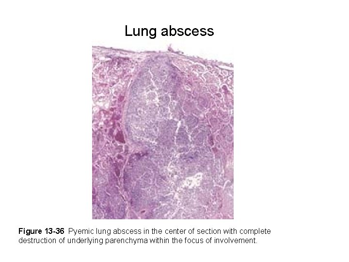 Lung abscess Figure 13 -36 Pyemic lung abscess in the center of section with