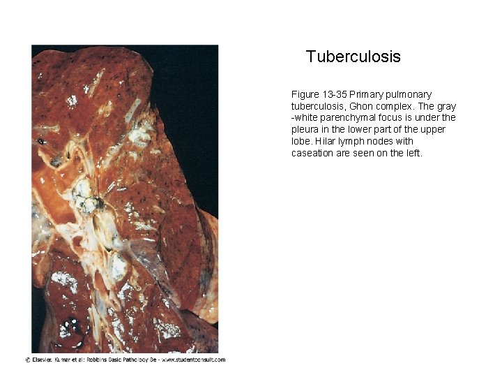 Tuberculosis Figure 13 -35 Primary pulmonary tuberculosis, Ghon complex. The gray -white parenchymal focus
