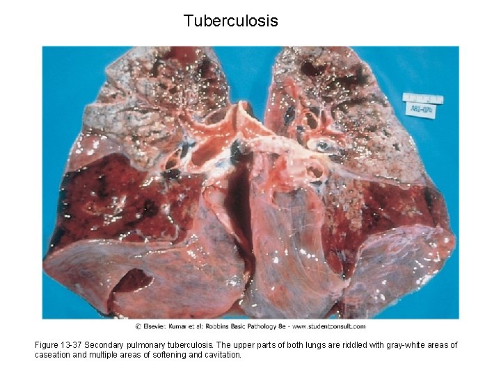 Tuberculosis Figure 13 -37 Secondary pulmonary tuberculosis. The upper parts of both lungs are