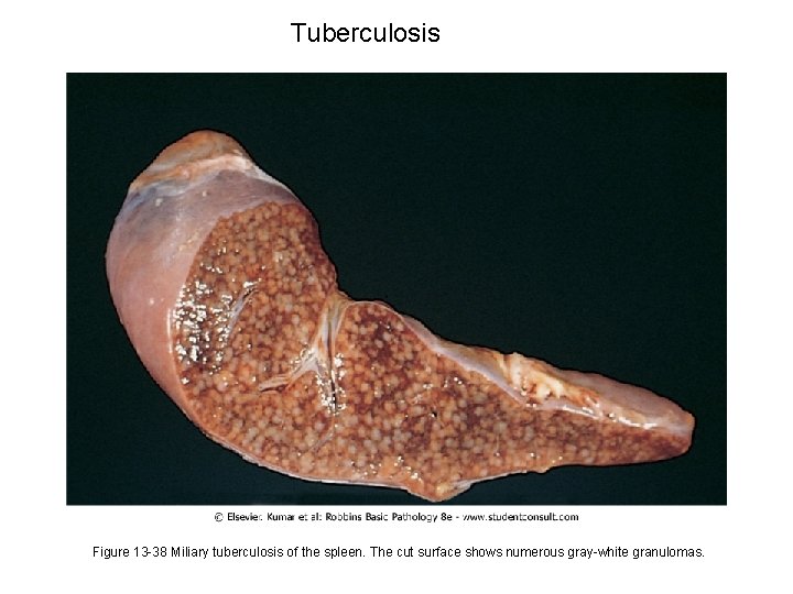 Tuberculosis Figure 13 -38 Miliary tuberculosis of the spleen. The cut surface shows numerous