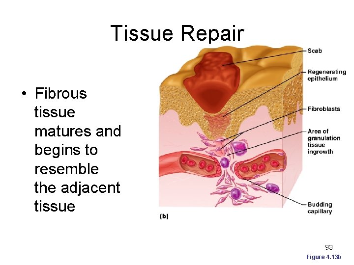 Tissue Repair • Fibrous tissue matures and begins to resemble the adjacent tissue 93