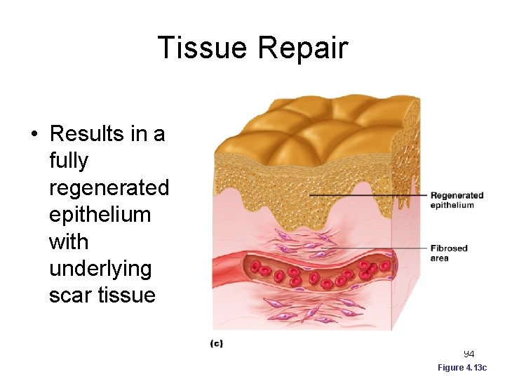 Tissue Repair • Results in a fully regenerated epithelium with underlying scar tissue 94