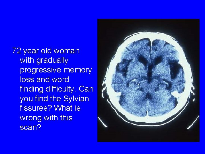 72 year old woman with gradually progressive memory loss and word finding difficulty. Can