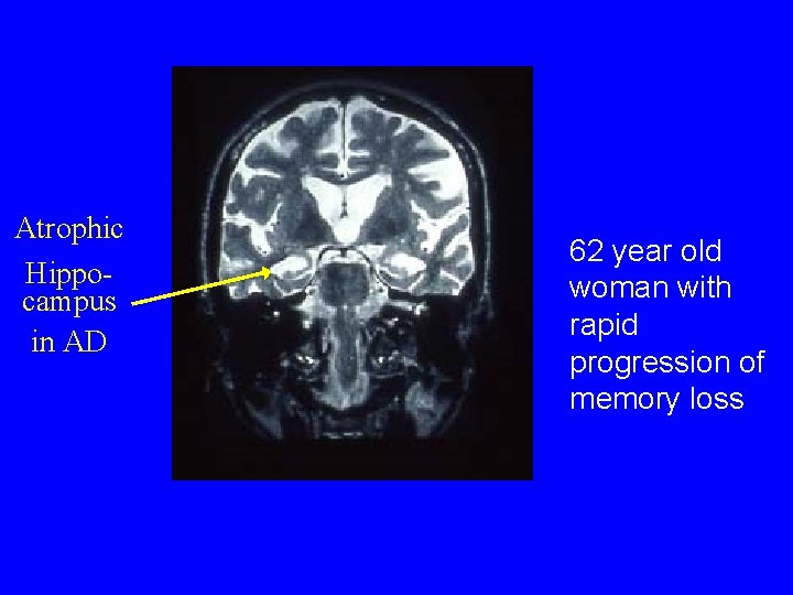 Atrophic Hippocampus in AD 62 year old woman with rapid progression of memory loss