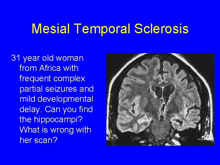 Mesial Temporal Sclerosis 31 year old woman from Africa with frequent complex partial seizures