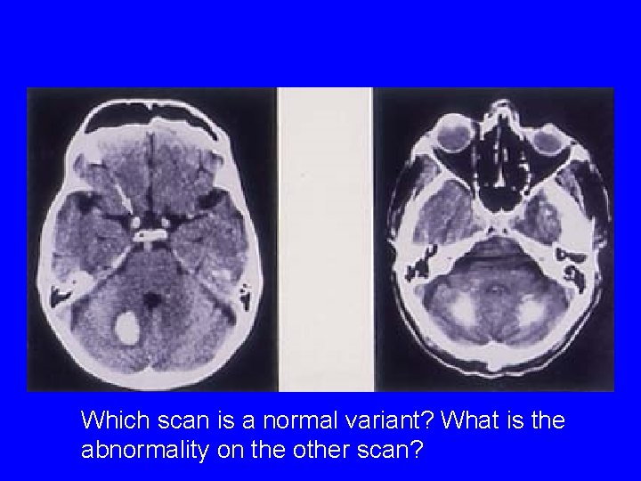 Which scan is a normal variant? What is the abnormality on the other scan?