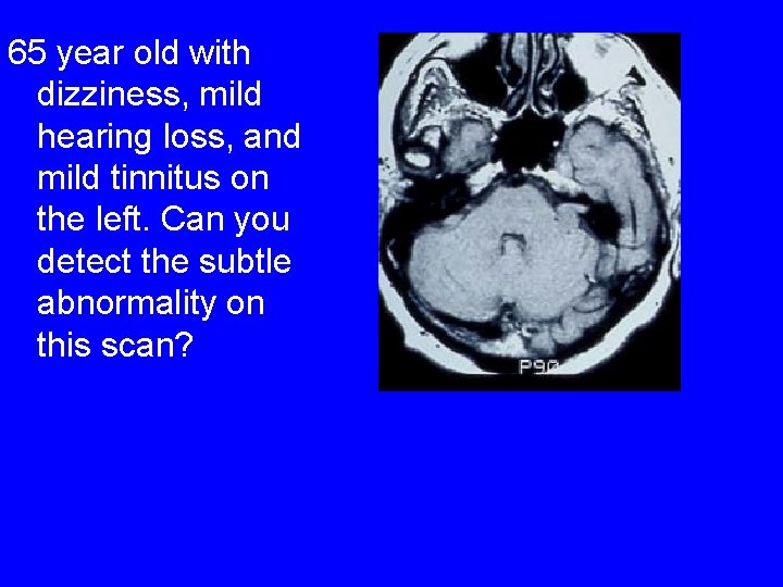 65 year old with dizziness, mild hearing loss, and mild tinnitus on the left.