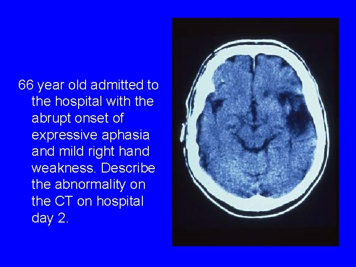 66 year old admitted to the hospital with the abrupt onset of expressive aphasia