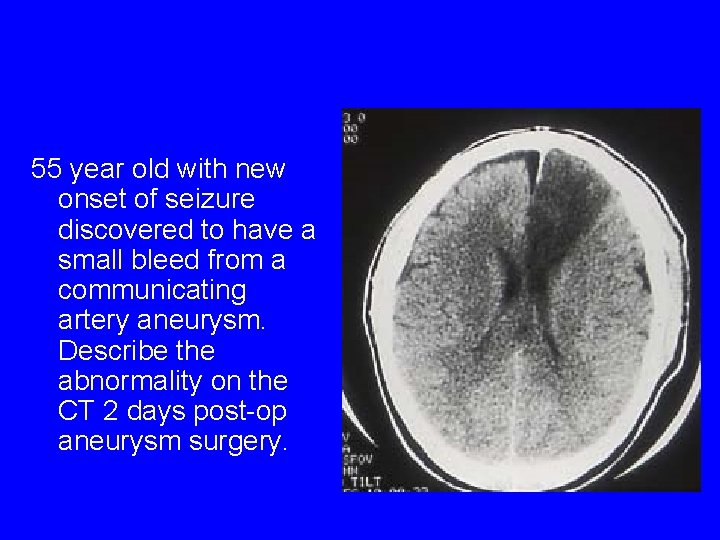 55 year old with new onset of seizure discovered to have a small bleed