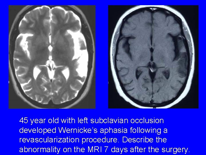 45 year old with left subclavian occlusion developed Wernicke’s aphasia following a revascularization procedure.