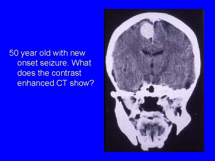 50 year old with new onset seizure. What does the contrast enhanced CT show?