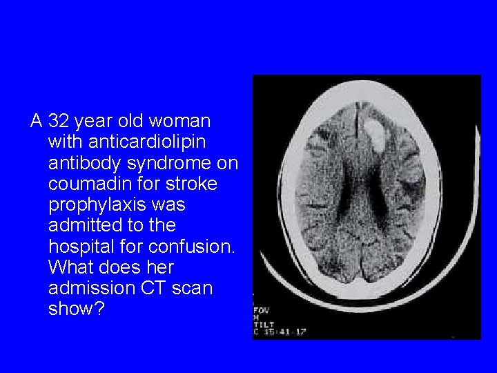 A 32 year old woman with anticardiolipin antibody syndrome on coumadin for stroke prophylaxis