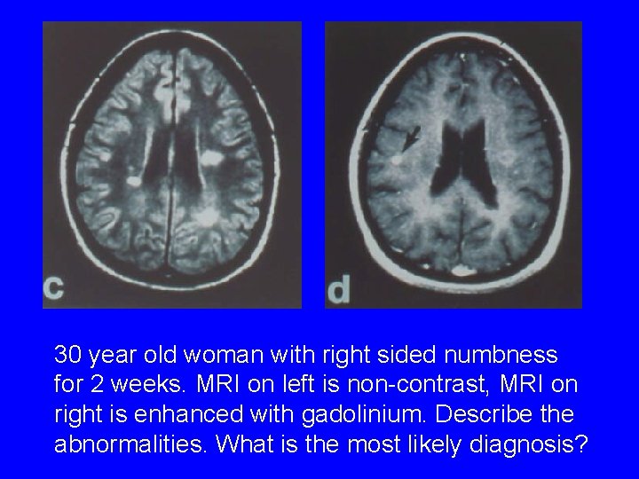 30 year old woman with right sided numbness for 2 weeks. MRI on left