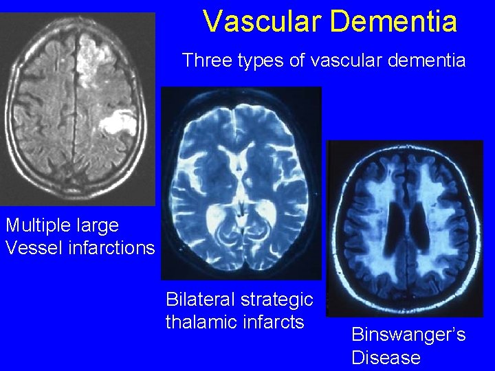 Vascular Dementia Three types of vascular dementia Multiple large Vessel infarctions Bilateral strategic thalamic