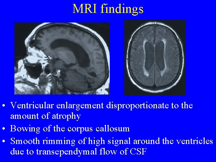 MRI findings • Ventricular enlargement disproportionate to the amount of atrophy • Bowing of